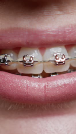 Close-up of teeth with braces
