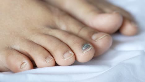 foot with discolored toenails