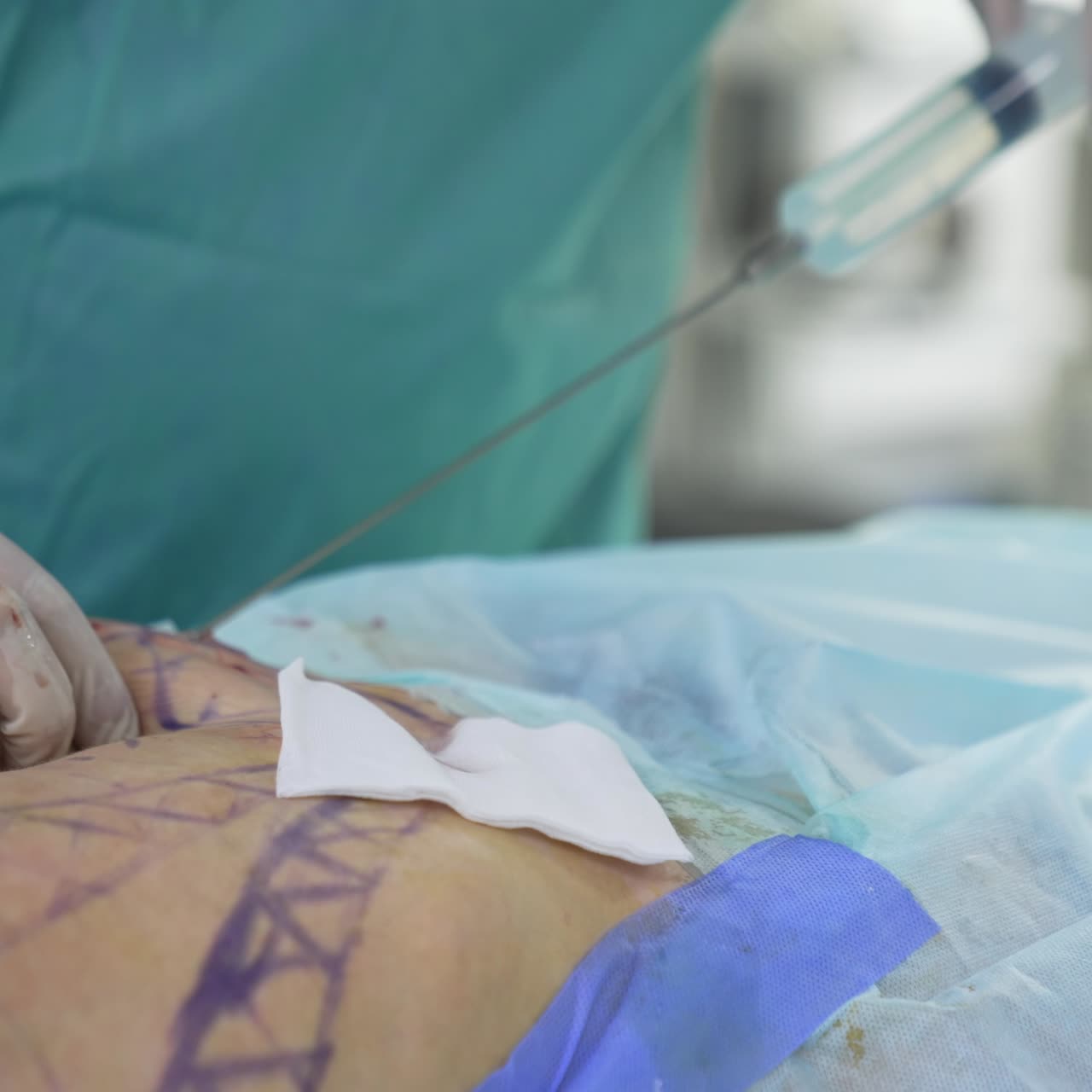 Body lifting. Patient's body during plastic surgery. Doctor in safety gloves performing a medical procedure in operating room. Close-up