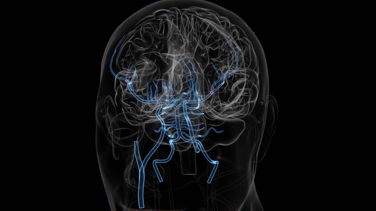 Ischemic Brain Stroke in HD Video | Stroke Ischemic HD Video | Brain Stroke
