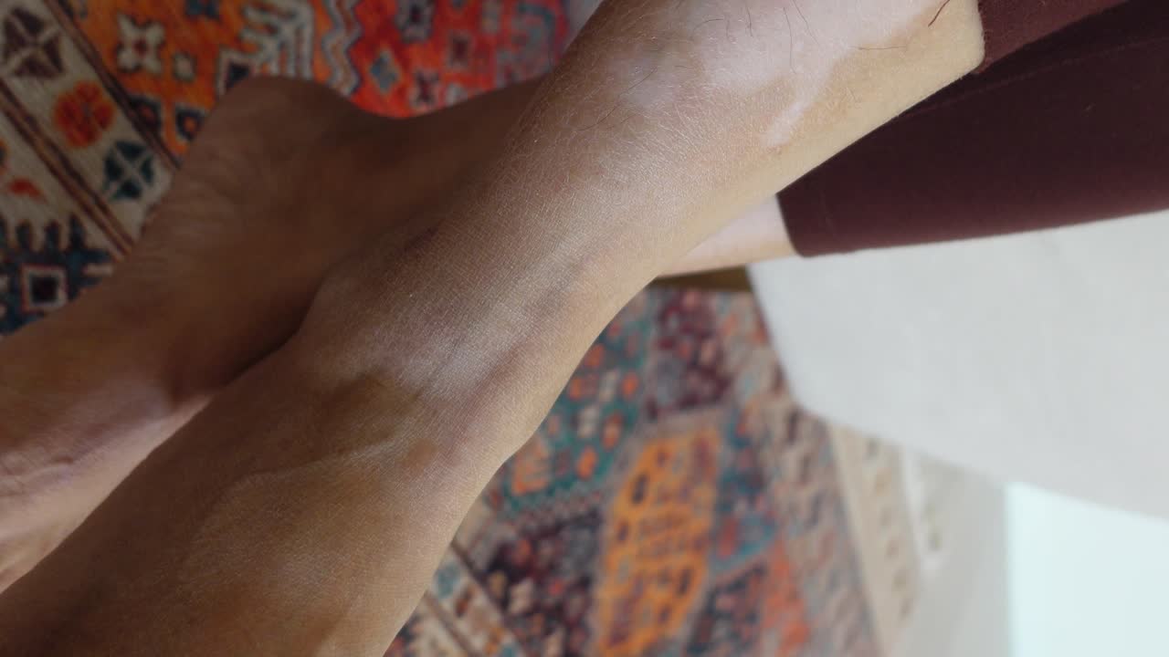 Close-up of a person's leg with vitiligo
