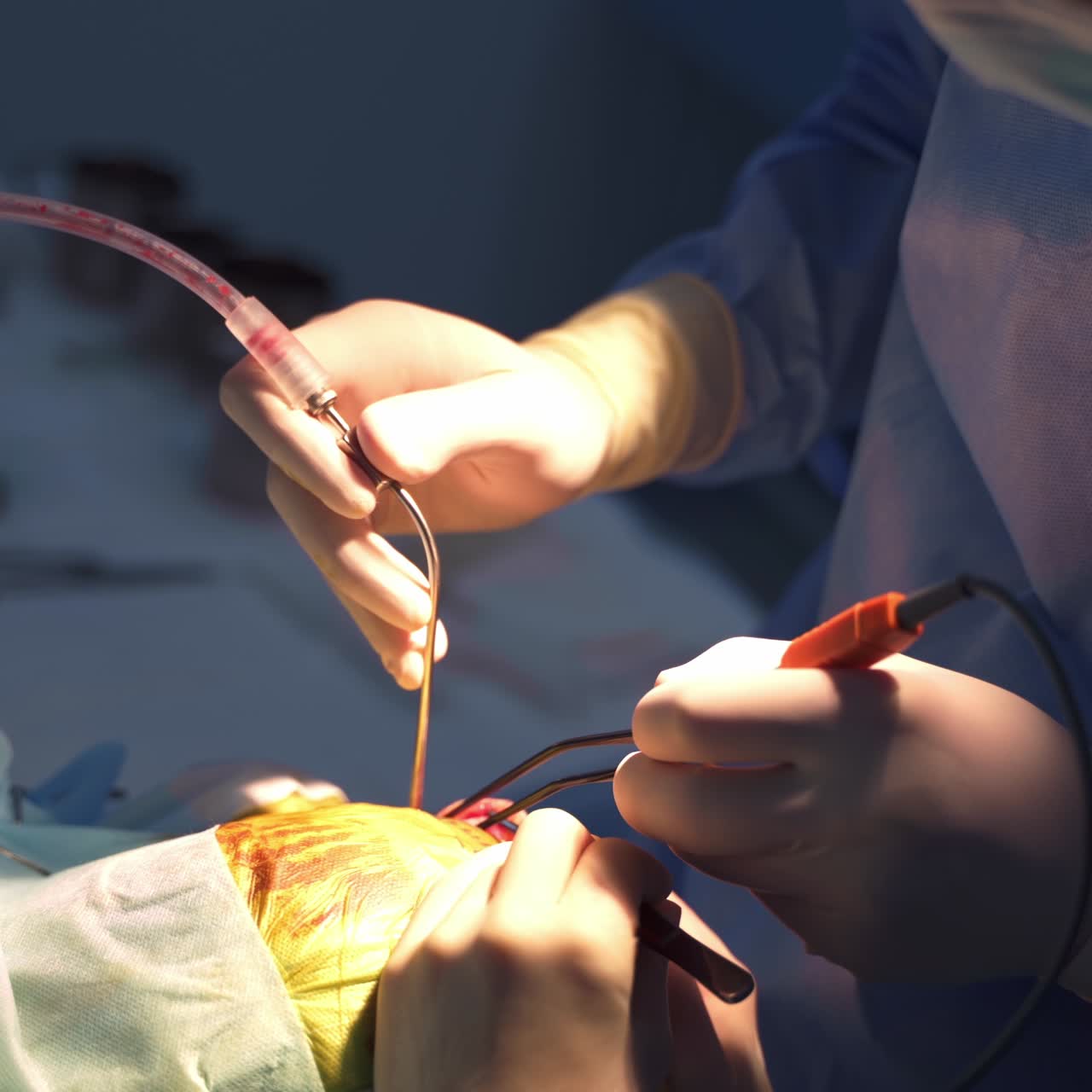 Neurology operation in action. Surgery professionals operate the patient using electric instruments. Close up