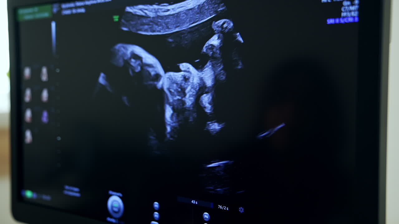 Fetal Ultrasound Image
