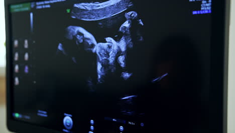fetal ultrasound image