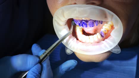 el dentista esparce gel oral azul en los dientes de la mujer, el paciente guarda la boca de cerca, el ortodontista cuida los dientes.