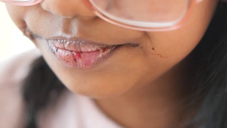 child with lip irritation and food stains