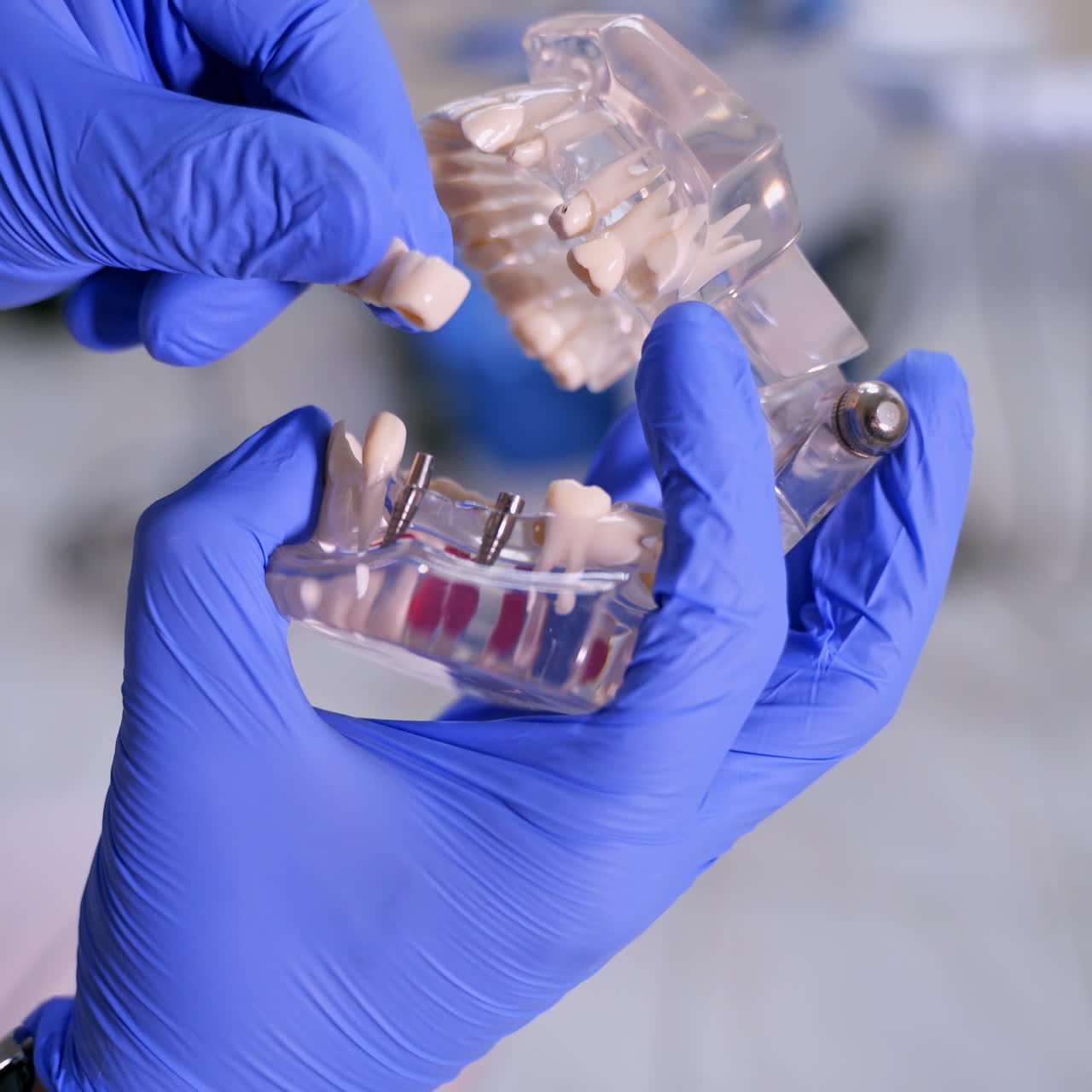 Doctor shows fake implants on a plastic jaw sample or model. Modern dental clinic background. Blue medical gloves on doctor's hands. Dental Hygiene and Health concept video. Implants in jaw.