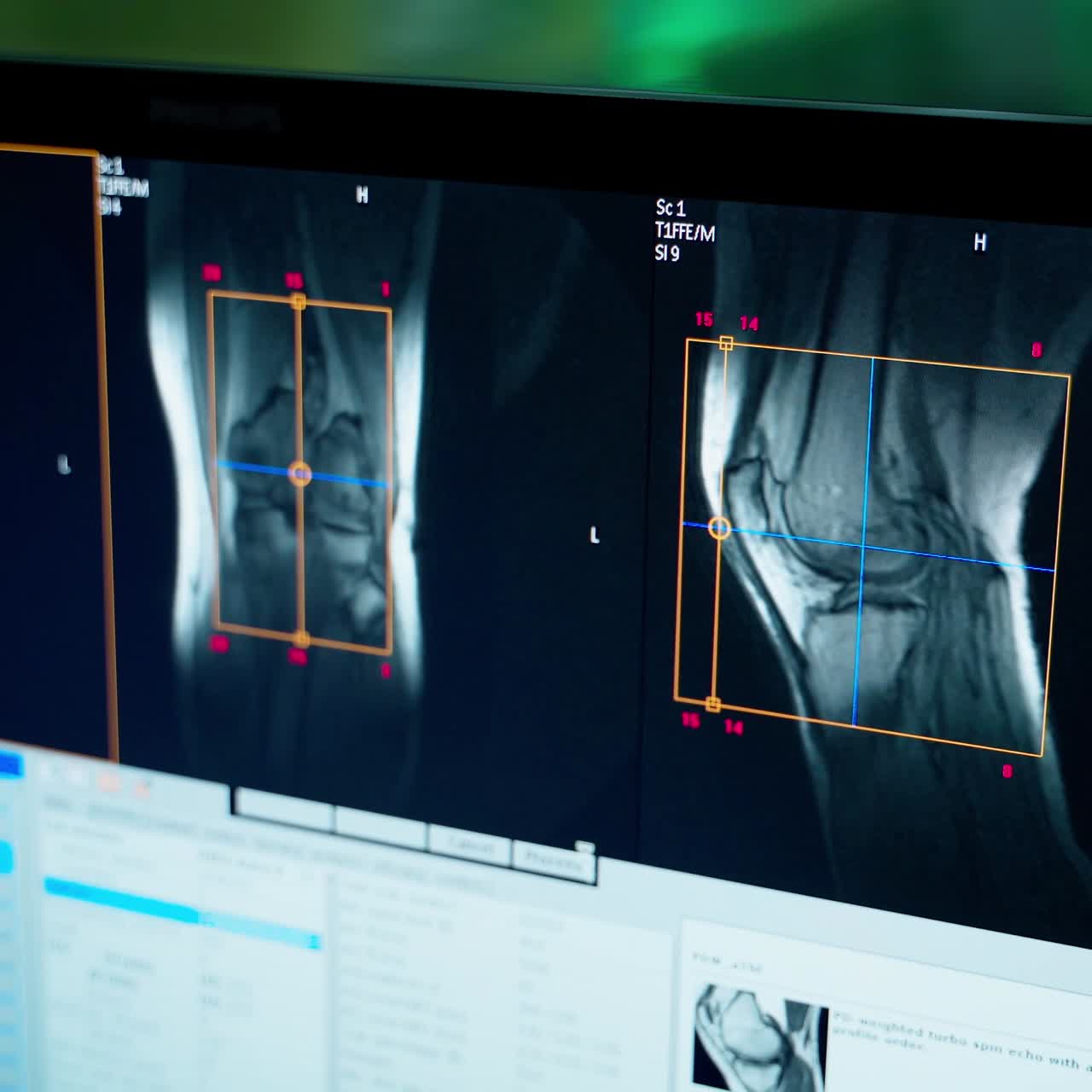 Computer shows the tomography pictures. Screen displays patient's bones. Medical worker analysis the results of mri diagnostic in the laboratory room.