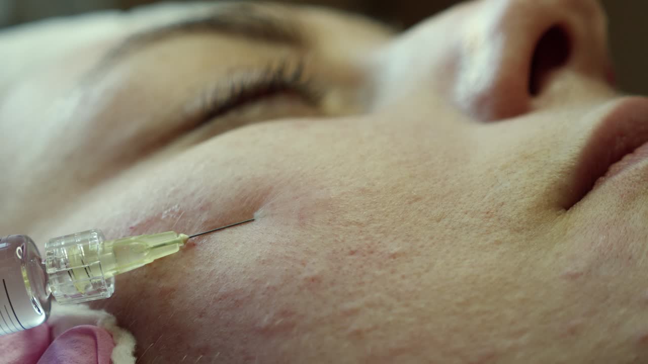 Dermal Filler Injection