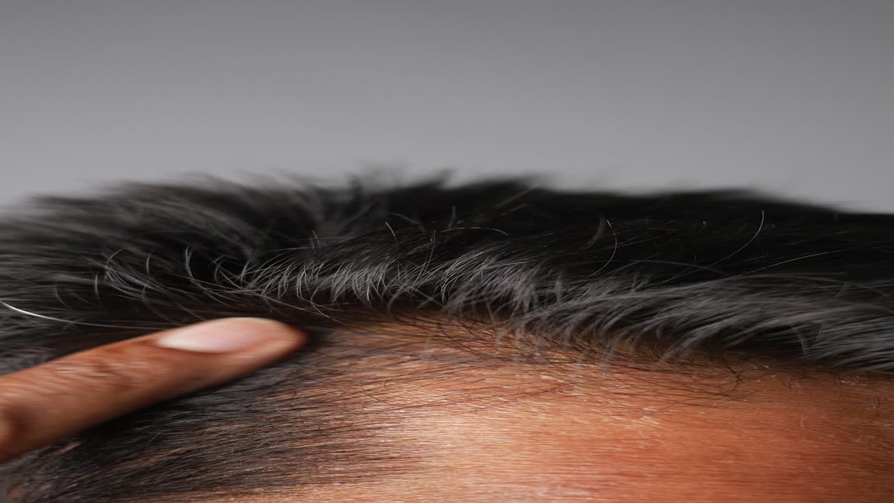 Close-up of a person's scalp with a finger pointing to a receding hairline.