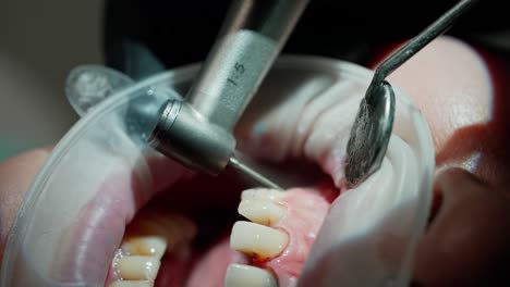 patient's mouth during tooth treatment. dentist's hands working with dental tools to treat sick tooth. stomatology procedure. close-up.