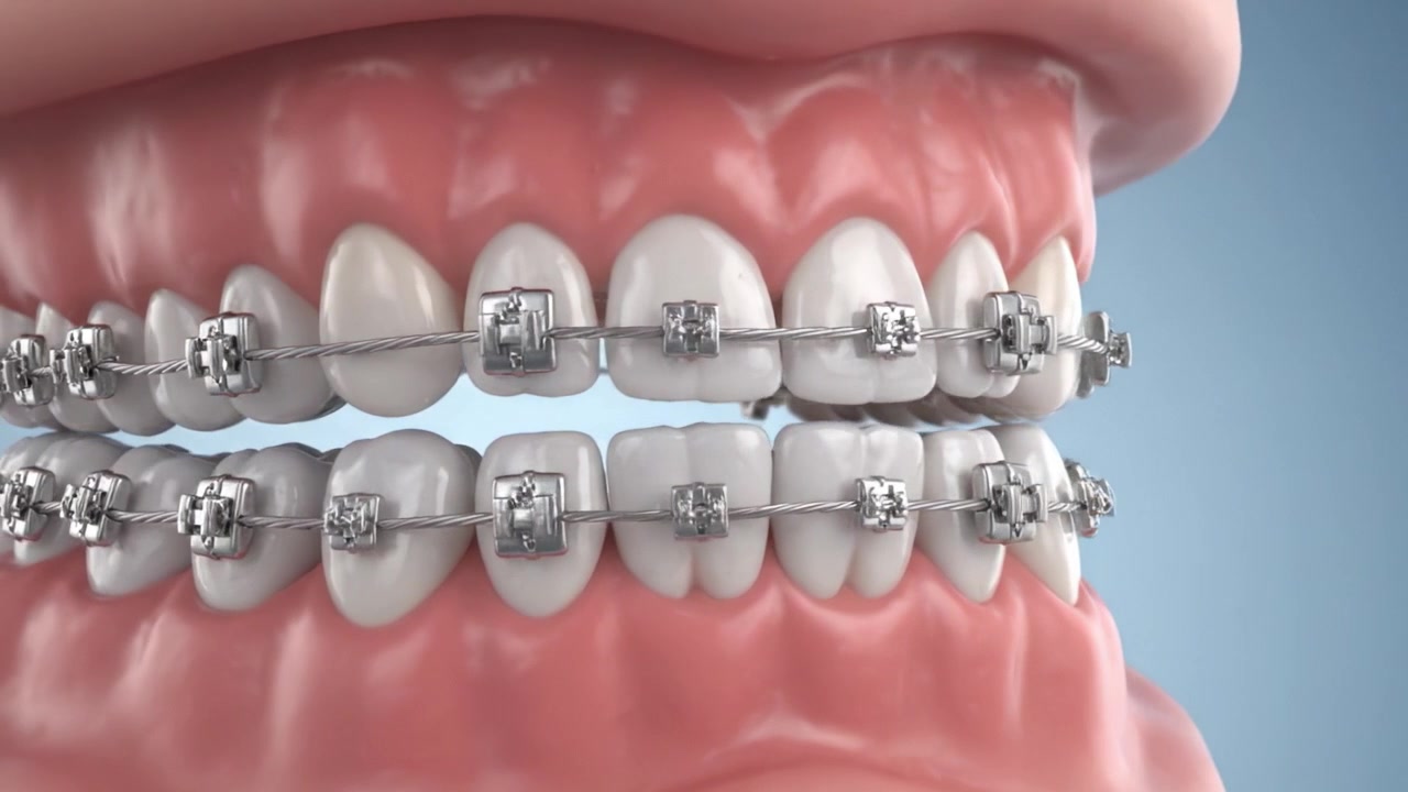 Close-up View of a Human Mouth with Dental Braces Displaying Orthodontic Appliances and Teeth Alignment in Two Distinct Frames for a Clear Comparison