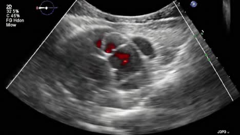 ultrasound imaging of a fetus: an insightful observation from early stages of pregnancy, highlighting important developmental features through lifesaving technology