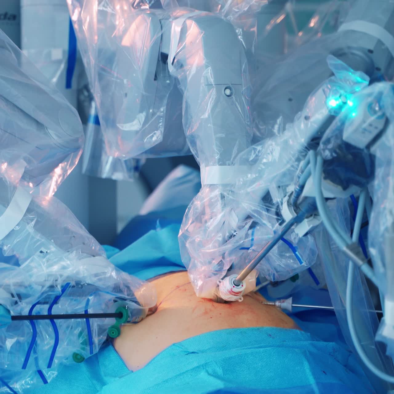 Medical operation involving robot. Medical robot. Robotic Surgery.