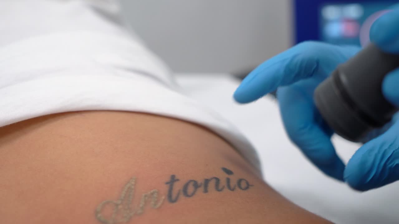 chica borrando tatuaje del nombre del ex novio, borrando o quitando