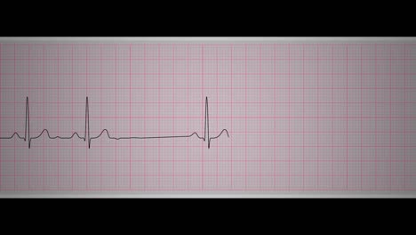 ekg sinoatrial block