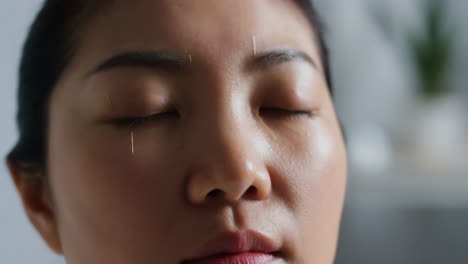close-up of a woman receiving facial acupuncture treatment