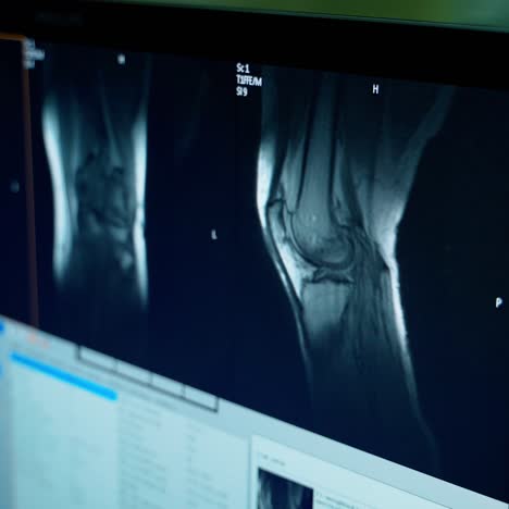 x-ray photos on the monitor in medical control room. doctor examining patient's bones on the screen of a computer in hospital. close-up.