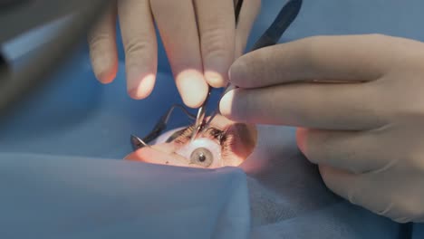 surgery team making strabismus surgery using modern technologies, latest devices in modern clinic, the surgeon sews up the eye