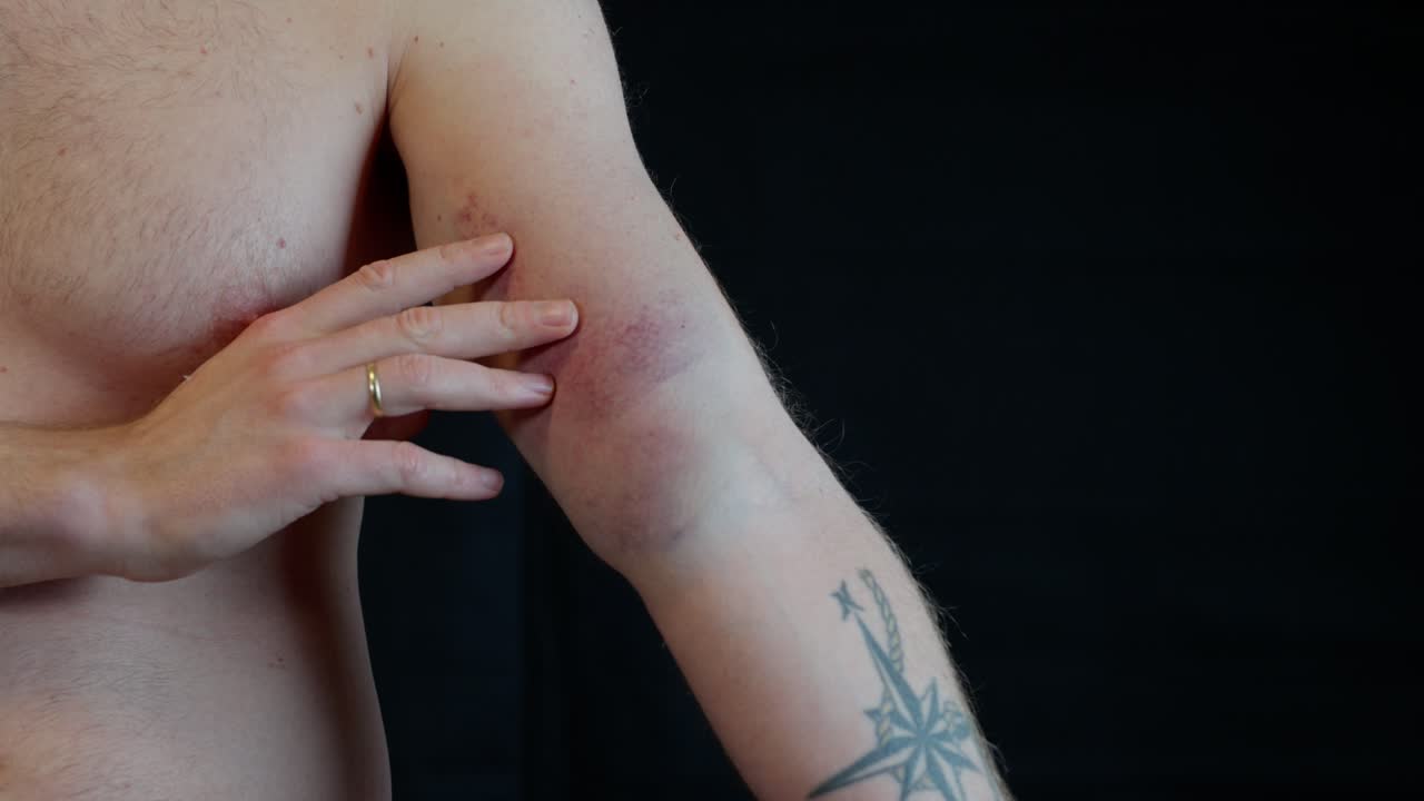 Man standing on black background shows severe bruising on left arm after tearing biceps, push in to focus on hurt area.