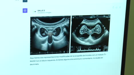 thyroid ultrasound images with nodule