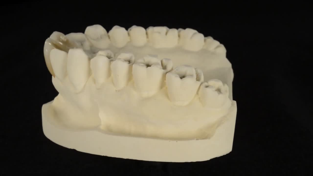 molde dental giratorio con coronas de cerámica en los dientes incisivos centrales