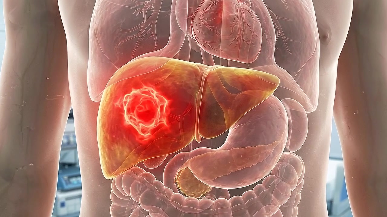 Animazione medica 3D del fegato umano con tumore