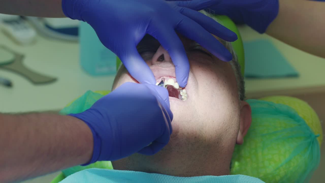 Teeth implant deinstaletion process. Close up dentist hands removing denture
