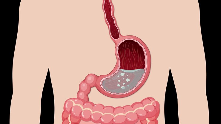 Anatomical diagram showing gas bubbles forming and expanding within the human stomach and digestive tract.