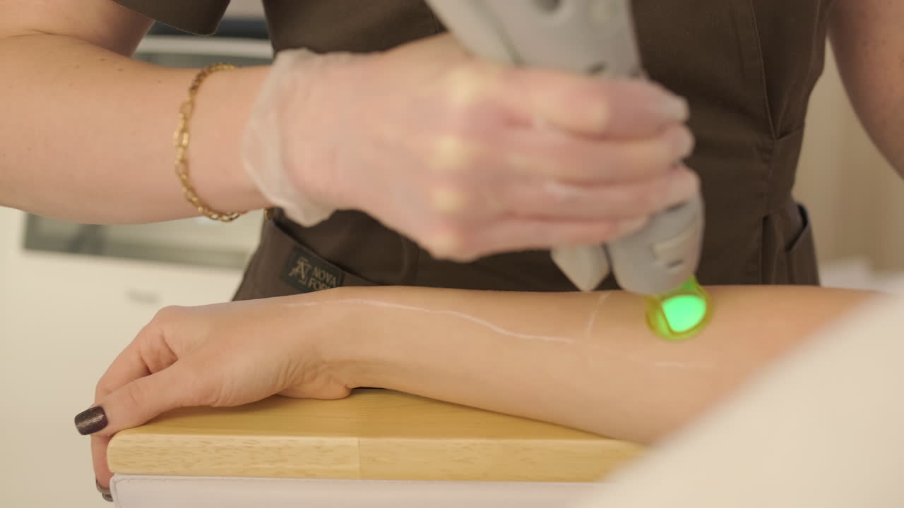 Close-Up of Laser Hair Removal Treatment on a Woman's Arm