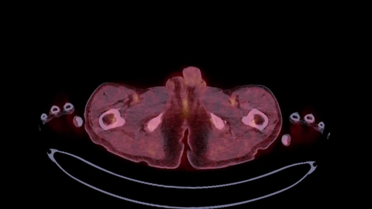 ct (tomografía por emisión de positrones) de todo el cuerpo humano 3d renderización de imagen tono de color rojo vista axial para detectar la recurrencia del tumor después de la cirugía.