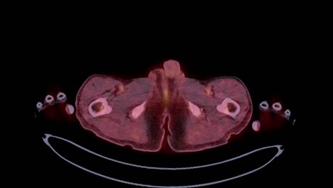 pet ct ( positron emission tomography )  of whole human body 3d rendering image red color tone axial view for detect tumor recurrence after surgery.