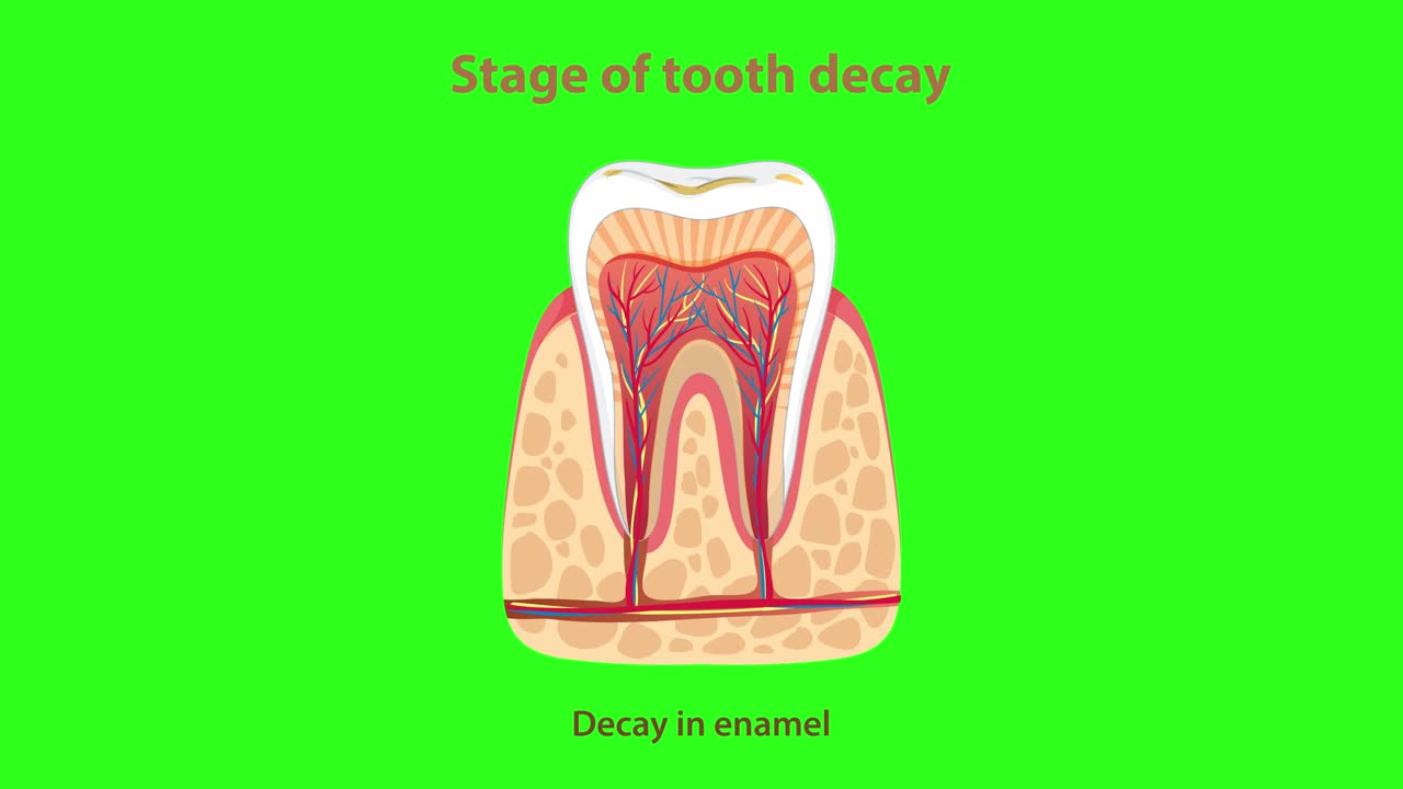 Medical animation visually explains the sequential stages of tooth decay, using cross-sectional tooth diagrams, clear labeling, and a bright green chroma key background