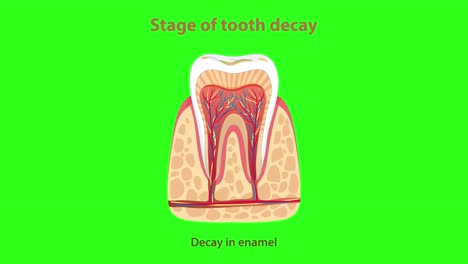 Medical animation visually explains the sequential stages of tooth decay, using cross-sectional tooth diagrams, clear labeling, and a bright green chroma key background