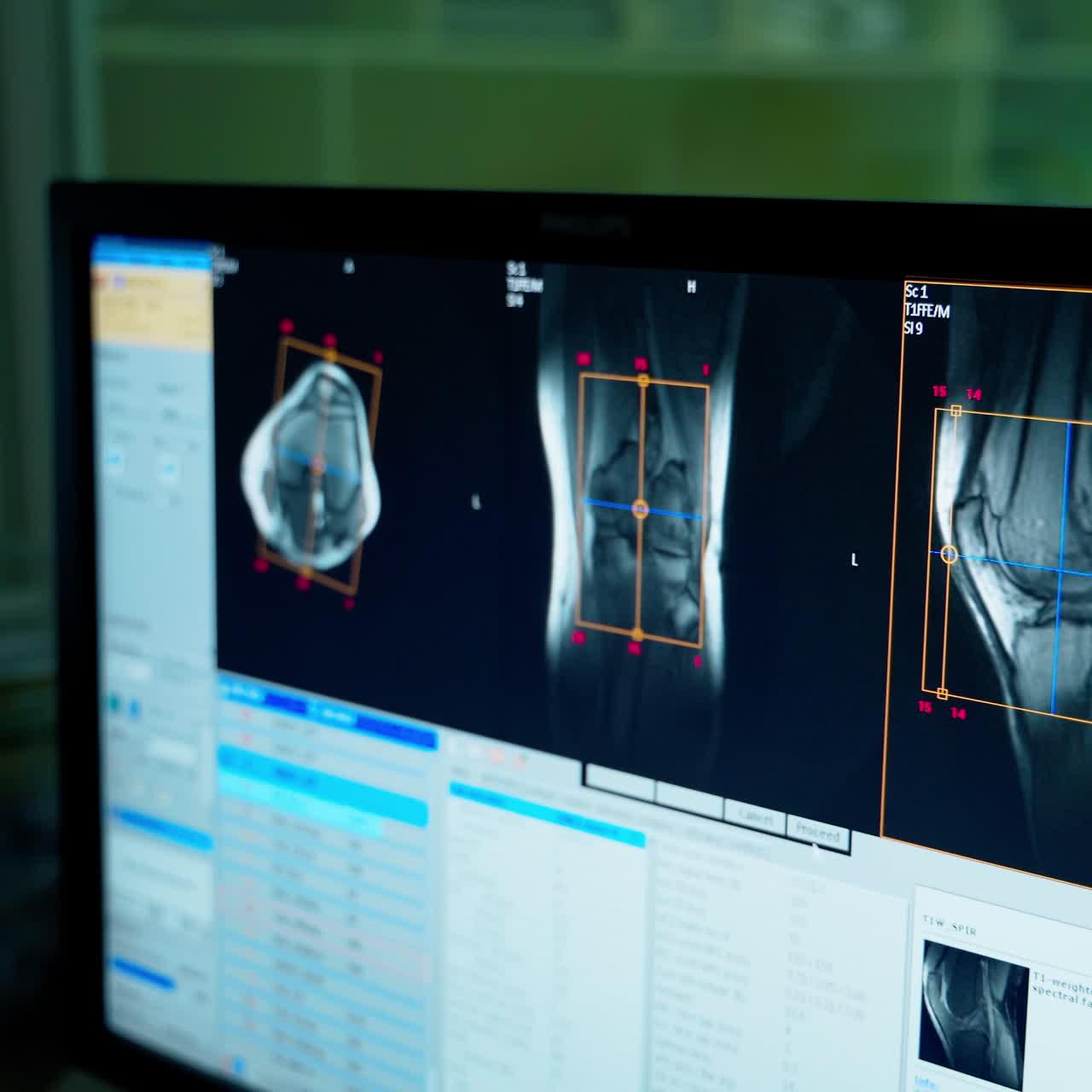 X-ray shots on the monitor. Pictures of patient's bones on the computer on the background of mri machine in the medical control room. Close-up.