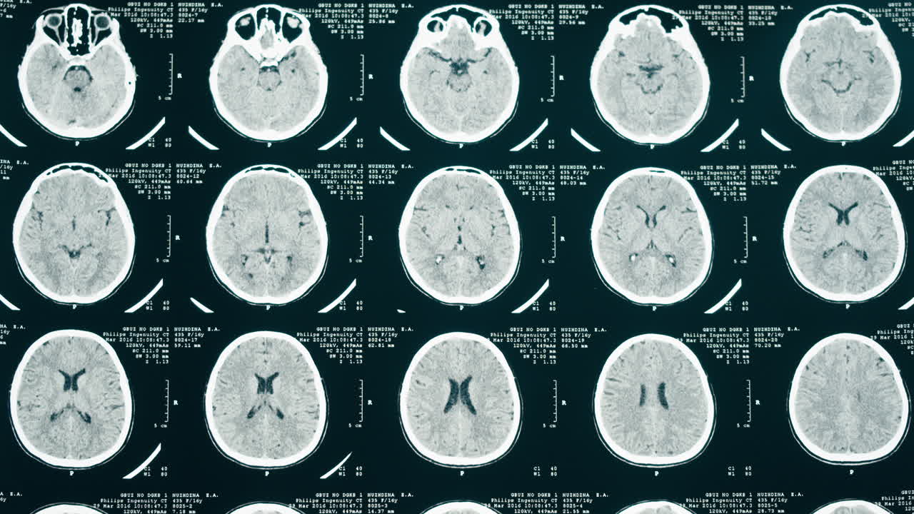 Immagini di TAC mediche del cervello umano per la diagnosi