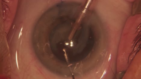 macro footage of eyes during eye surgery. ophthalmological surgery.