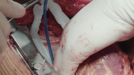 process of surgery in cardiology. surgeon hand attaches new grafts to divert blood supply. medic grafts vessels onto coronary arteries beyond blockage