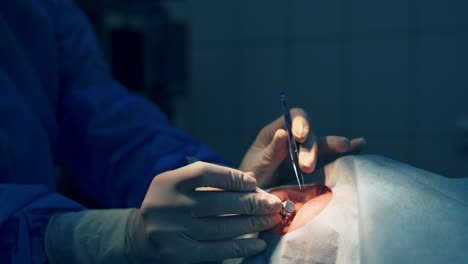 ophthalmology operation. surgeon's hands in gloves performing eye vision correction. modern clinic and equipment. selective video focus.