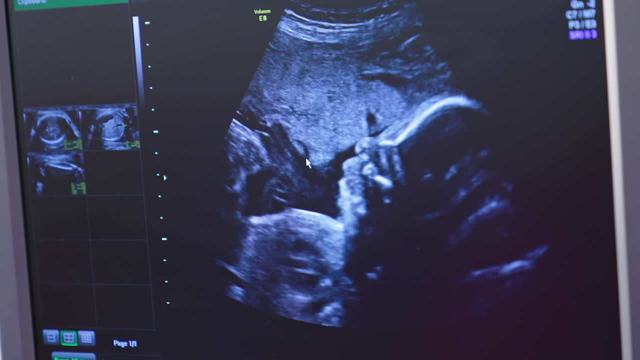Ultrasonography of pregnant woman. Tiny baby is turning in mother's belly. Baby in mother's womb is moving during sonography.