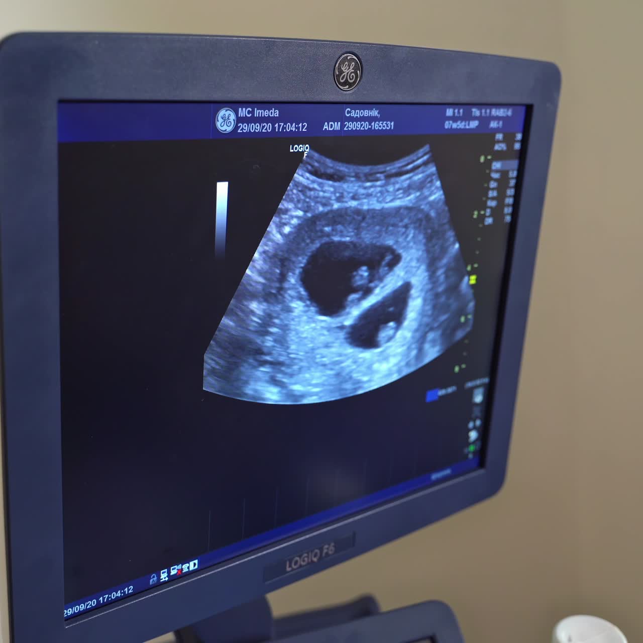 Ecografia di una persona su monitor. Sonografia. Lo schermo dell'ecografo. Concetto di assistenza sanitaria