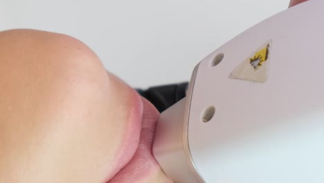 laser hair removal procedure on face