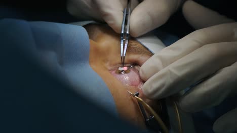 laser vision correction. a patient and team of surgeons in the operating room during ophthalmic surgery. eyelid speculum. lasik treatment. patient under sterile cover