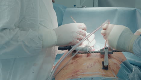 surgeon with nurse operates patient. doctor uses medical instruments while assistant controls stabilizing device during coronary artery bypass graft