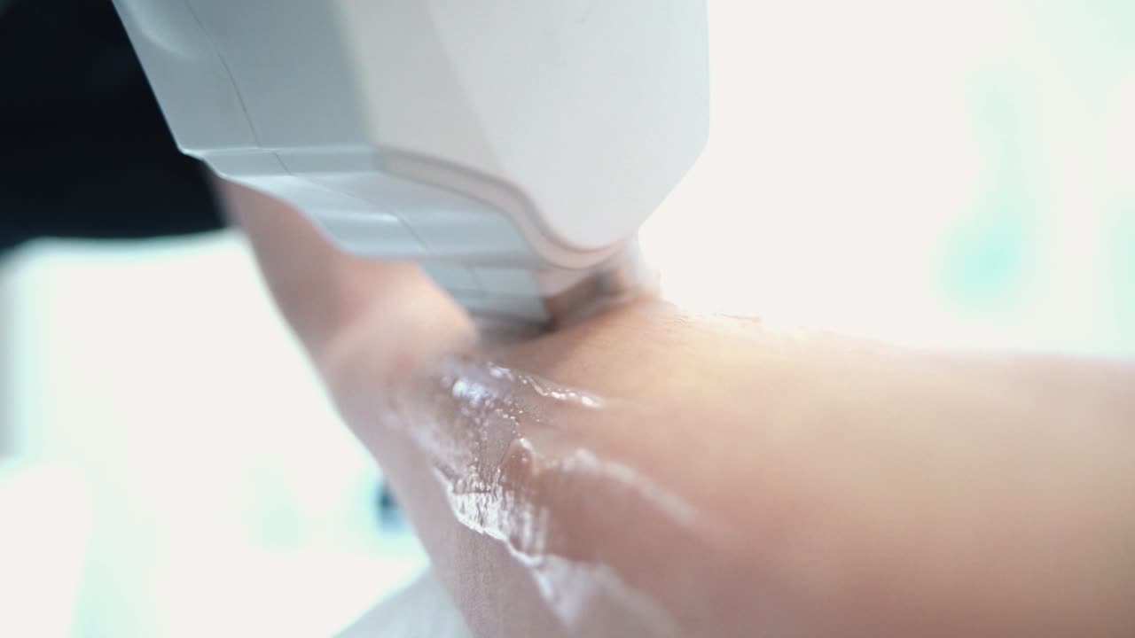 Laserhårfjerningsbehandling på arm
