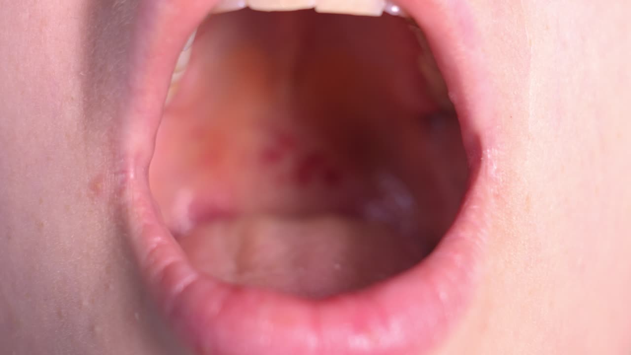 Close-up view of a person's mouth with red spots on the oral mucosa