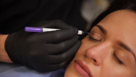 marking for eyelid surgery