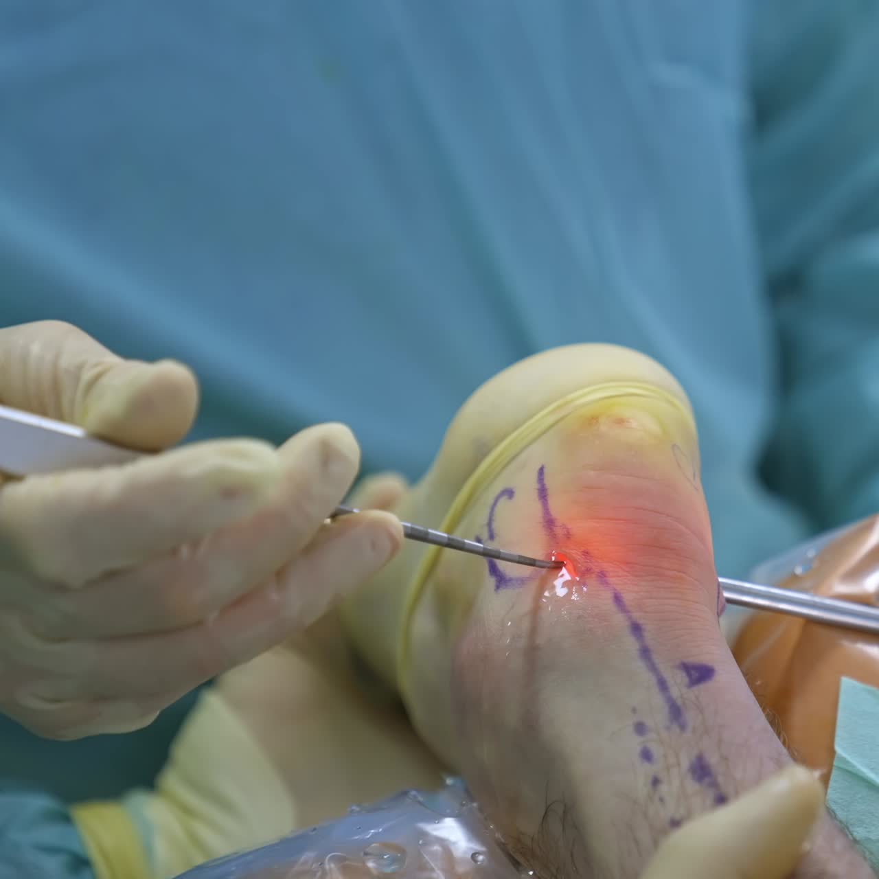 Medical staff in the operating room. Medical professional doctors performing surgery operation