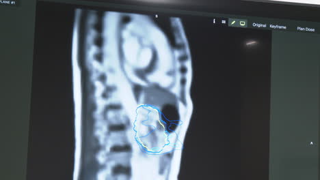 medical image - ct scan with tumor contour