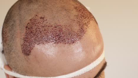 the top of a man's head right after a hair transplant by the fue method